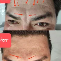 لیزر خال /میخچه زگیل/ ژل بوتاکس|خدمات آرایشگری و زیبایی|قم, صفائیه|دیوار