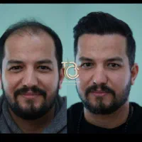 کاشت مو / کاشت ابرو /رفع غبغب