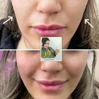 تزریق ژل و بوتاکس و آموزش حرفه ای|خدمات آرایشگری و زیبایی|اهواز, سپیدار|دیوار