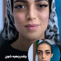 آف 10 درصدی ژل و بوتاکس فقط 550