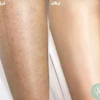 لیزر موهای زائد با آخرین تکنولوژی دستگاه|خدمات آرایشگری و زیبایی|تهران, زعفرانیه|دیوار