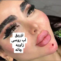 ژل بوتاکس رفع چین وچروک آنزیم مادلینگ پی آرپی خال