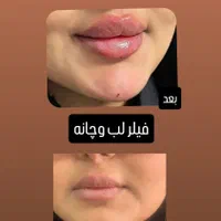 تزریق ژل وبوتاکس با بهترین قیمت در برازجان|خدمات آرایشگری و زیبایی|برازجان, |دیوار