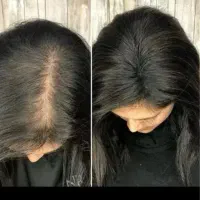 با بهترین قیمت،کاملا طبیعی ریزش مو را کنترل نمایید