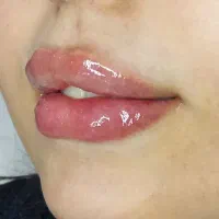 تزریق ژل، بوتاکس و خدمات کامل جوانسازی پوست