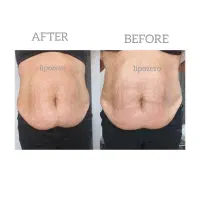 دستگاه لاغری وجوانسازی لیپوزیرو|خدمات آرایشگری و زیبایی|فارسان, |دیوار