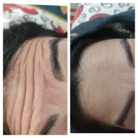 معجزه بوتاکس