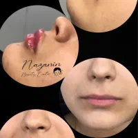 بوتاکس، فیلر و خدمات پیرسینگ|خدمات آرایشگری و زیبایی|رشت, خواهر امام|دیوار