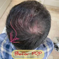 پی آر پی مو و صورت،مزوتراپی،اگزوزوم،PRF|خدمات آرایشگری و زیبایی|تهران, حر|دیوار