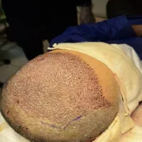 کاشت مو|خدمات آرایشگری و زیبایی|ایلام, |دیوار