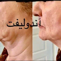 ساکشن غبغب شکم پهلو|خدمات آرایشگری و زیبایی|شیراز, عفیف‌آباد|دیوار
