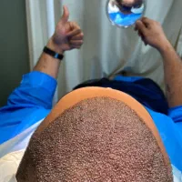 کاشت مو و ابرو