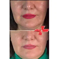 شادابی و جوانسازی صورت با تزریق پروفایلو|خدمات زیبایی و سلامت|شیراز, معالیآباد|دیوار