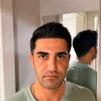 کاشت مو و ابرو طبیعی