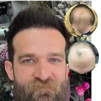 جشنواره پاییزی کاشت مو و ابرو سوپر میکرو کاشت