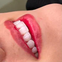 کامپوزیت دندان جشنواره لمینت ایمکس|خدمات آرایشگری و زیبایی|تهران, شمس‌آباد|دیوار