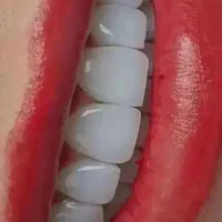 دندانپزشکی ، ایمپلنت، روکش، کامپوزیت ، عصب کشی|خدمات آرایشگری و زیبایی|کوهدشت, |دیوار