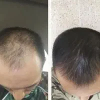 دیگه نگران کچلیت نباش
