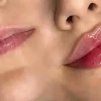 جشنواره فیلر لب فقط ۸۰۰  و جوانسازی صورت