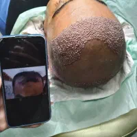 کاشت مو و ابرو پناه با تخفیف ویژه