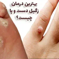 درمان قطعی زگیل|خدمات آرایشگری و زیبایی|رفسنجان, |دیوار