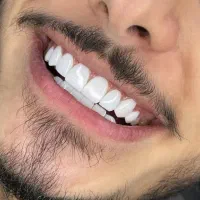 تخفیف کامپوزیت دندان