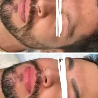 رفع نواقص ابرو و ریش در اقایان