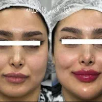 جشنواره کلیه خدمات زیبایی ژل بوتاکس وفیلر هایفو
