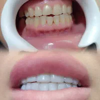 مشاوره کامپوزیت دندان و  بی دندانی