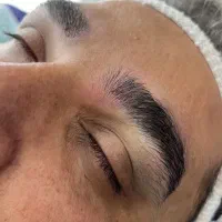 میکروکاشت با و بدون جراحی