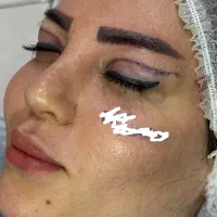 بلفارو پلاستی بدون جای بخیه تضمینی و فیلر و بوتاکس|خدمات آرایشگری و زیبایی|تبریز, |دیوار