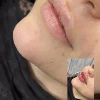 تزریق  تمامیه خدمات ژل فیلر بوتاکس آنزیم