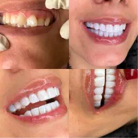 کامپوزیت دندان روکش لمینت با قیمت مناسب و اقساط|خدمات آرایشگری و زیبایی|ری, شهرری|دیوار