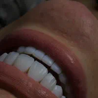 لمینت/ایمپلنت /کامپوزیت/روکش/عصبکشی|خدمات زیبایی و سلامت|تهران, سازمان برنامه شمالی|دیوار