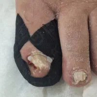 درمان ناخن تو گوشت رفته و قارچ گرفته|آرایشی، بهداشتی، درمانی|ارومیه, |دیوار