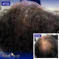 میکرواسکالپ / اسکالپ تخصصی سر/ جایگزین کاشت مو|خدمات آرایشگری و زیبایی|مشهد, وکیل‌آباد|دیوار