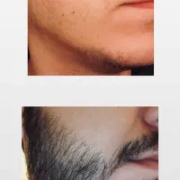 ریش کم پشت راه حلش اینجاست