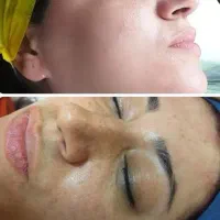 لیزر موهای زائد299هزار، هایفو،سفیدی پوست