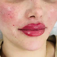 تزریق تخصصی ژل و بوتاکس