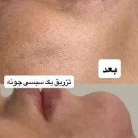 لاغری فیشیال لیفت صورت کربن تراپی