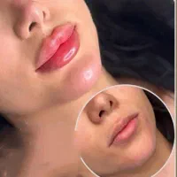 جشنواره تزریق ژل و بوتاکس در مطب با۴۰درصد تخفیف|خدمات آرایشگری و زیبایی|کرمانشاه, |دیوار