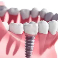 جشنواره ایمپلنت در عظیمیه کرج/فرصت محدود/ضمانتی