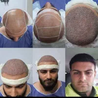 کاشت مو و ابرو