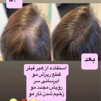 درمان ریزش مو و رویش مجدد با بهترین متریال|خدمات آرایشگری و زیبایی|تهران, امام حسین|دیوار