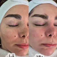 آف ویژه فیشال پوست