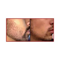 رویش مجدد مو و ریش