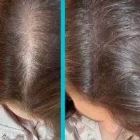 تراکم سازی ریشه ای|آرایشی، بهداشتی، درمانی|مشهد, سعد آباد|دیوار