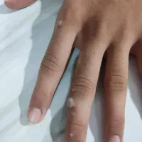 مشاوره رایگان بیماری hpv و hsv