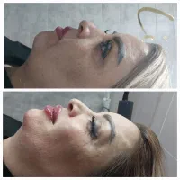 اموزش تزریقات زیبایی بوتاکس و فیلر و مزو