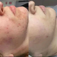ژل/فیلر/فیشیال/پاکسازی/پوست ومولیزر|خدمات آرایشگری و زیبایی|کرج, گوهردشت|دیوار